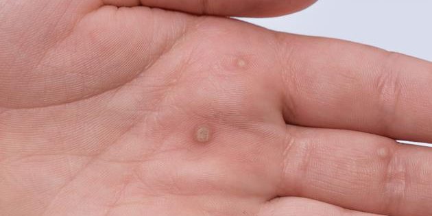 Papilloma virus nedir, Hpv hastaliginin tedavisi