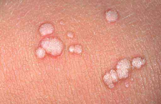 Hpv papillom nedir