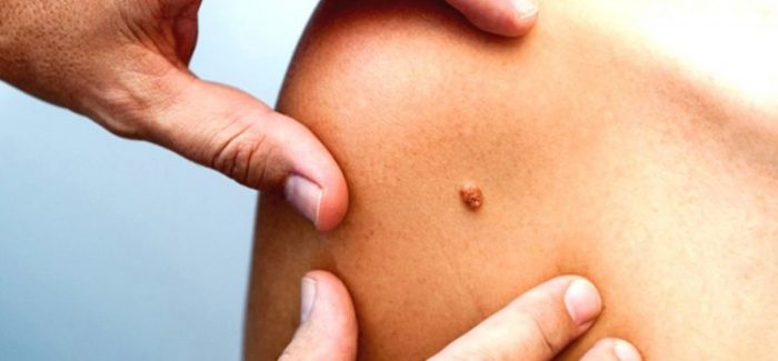 hpv-tedavisi hpv-tedavisi